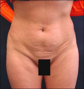Chicago Tummy Tuck Picture