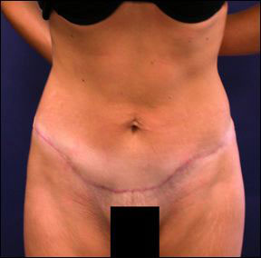 Chicago Tummy Tuck Picture