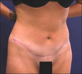 Chicago Tummy Tuck Picture