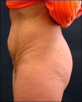 Chicago Tummy Tuck Picture