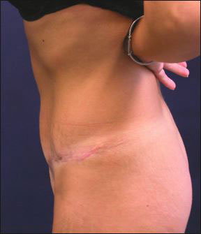 Chicago Tummy Tuck Picture