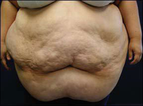 Panniculectomy - Patients Who Have Had Surgery