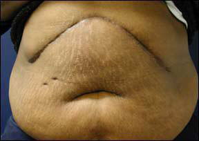 Panniculectomy - Tummy Tuck Covered by Insurance