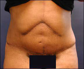 Panniculectomy - The After Results