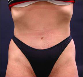 Chicago Abdominoplasty 
