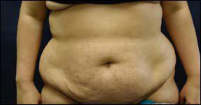 Abdominoplasty Photo - Female Result