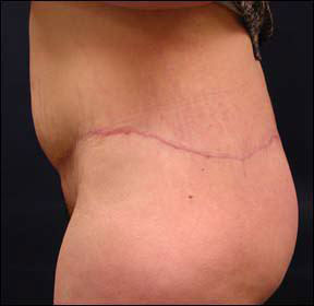 Butt - Buttock Lift Scars