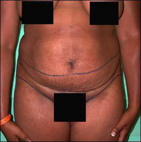 Tummy Tuck Picture