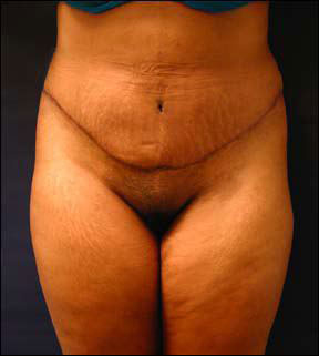 Tummy Tuck Picture