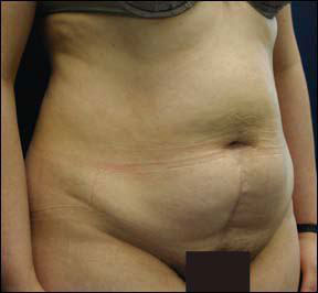 Tummy Tuck Picture - Before and After Pictures