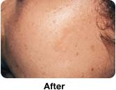Laser Mole Removal - Sample Pictures