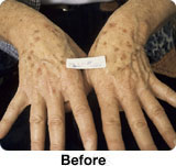 Laser Mole Removal - Hands and Arms