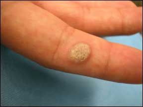 Wart - Rough Surface