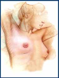 Chicago Breast Augmentation Procedure
