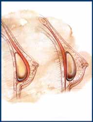 Chicago Breast Augmentation Procedure