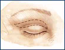 Chicago Eye Lift Surgery