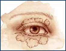 Chicago Eye Lift Surgery