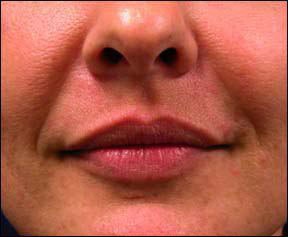 Botox Cosmetic - Lip Lines