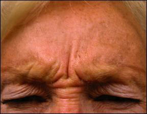 Crows Foot - Botox for the Crows Feet