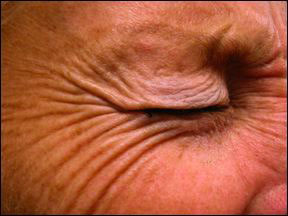 Crows Foot - Botox Picture