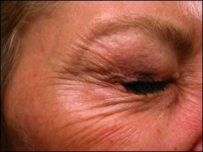 Botox Before and After - Age of Patients