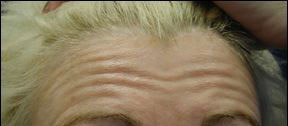 Anti Wrinkle - Crows Feet