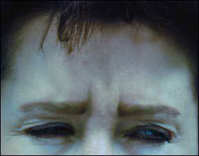 Botox Before and After - Patient Results