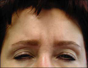 Botox Before and After - Forehead Picture