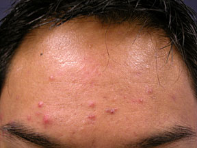 Acne Treatment - No Additional Treatment