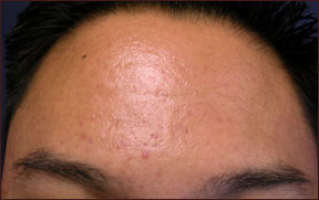 Acne Treatment - Dramatic Improvement