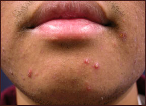 Acne Treatment - Severe Acne