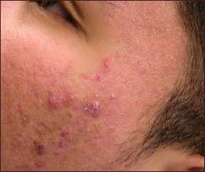Chicago laser acne removal