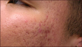 Chicago laser acne removal