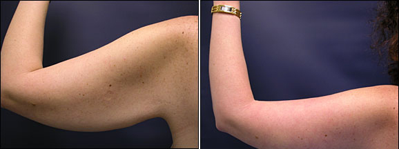Arm - Rejuvenate Your Arms