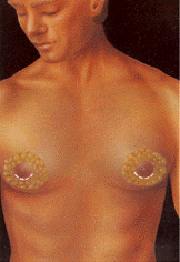 After surgery, the breast mound is restored. Scars are permanent, but will fade with time. The nipple and areola are reconstructed at a later date.