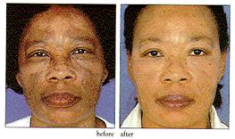 Melasma