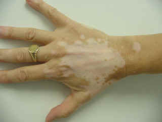 Vitiligo