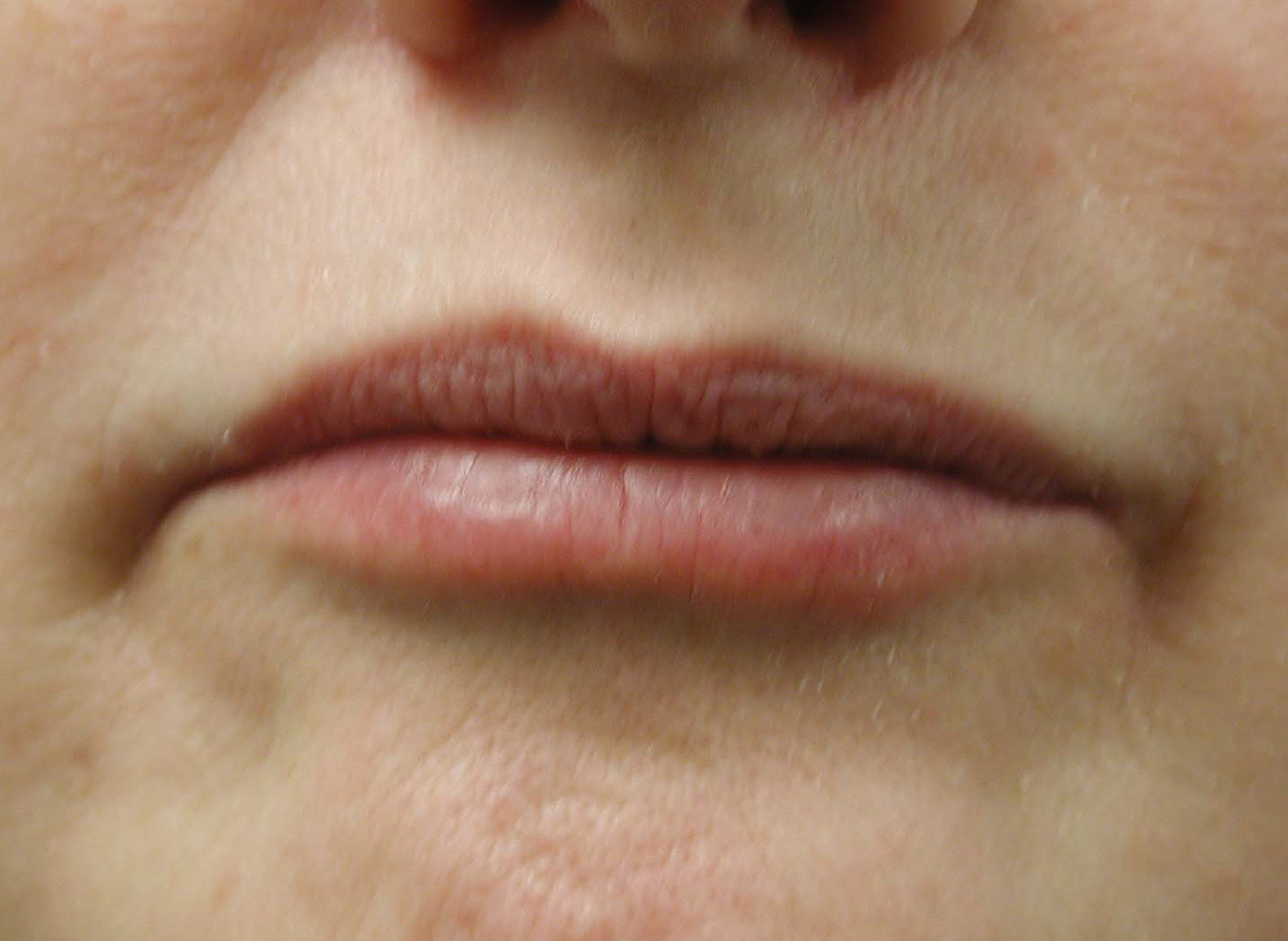 Chicago Collagen Lip Injections View the Result of Chicago Collagen