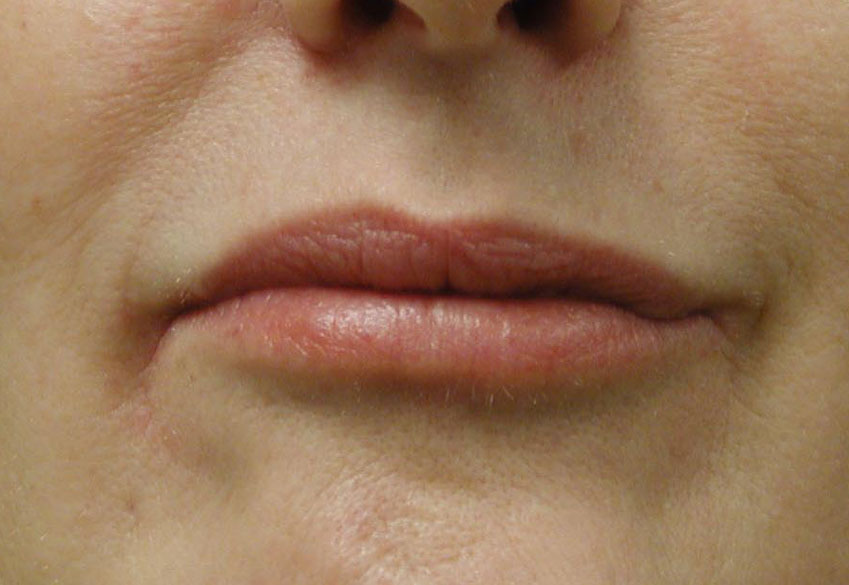 Chicago Collagen Lip Injections View the Result of Chicago Collagen