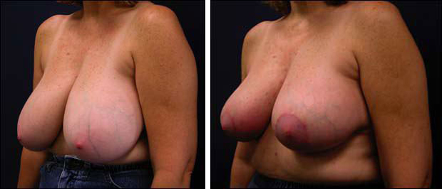 BreastReduction