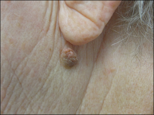Seborrheic Keratosis Symtomp Causes And Treatment Chicago