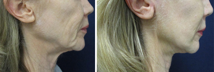 Chicago facelift surgeon cosmetic surgery