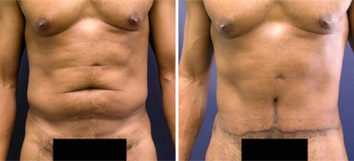 Tummy Tuck Surgery Before and After Pictures