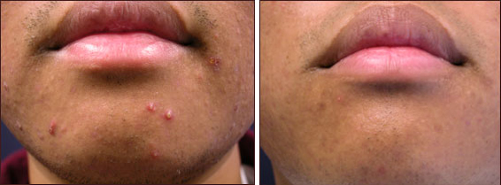 acne_treatment