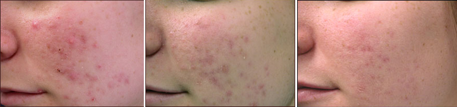 acne_treatment