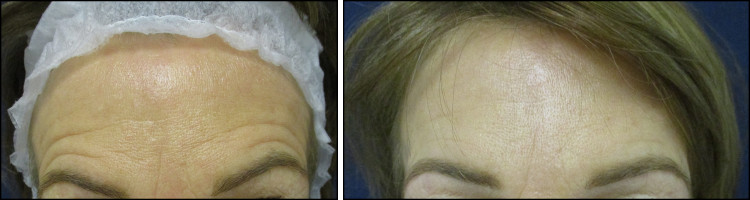 Chicago Botox | Cosmetic Injections | Botox Before and After Images