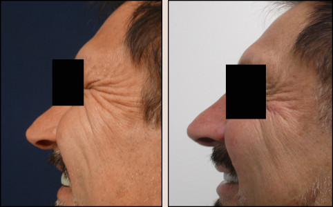Chicago Botox | Cosmetic Injections | Botox Before and After Images