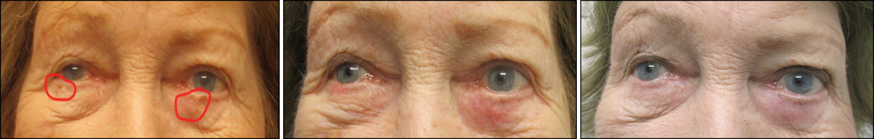 facelift