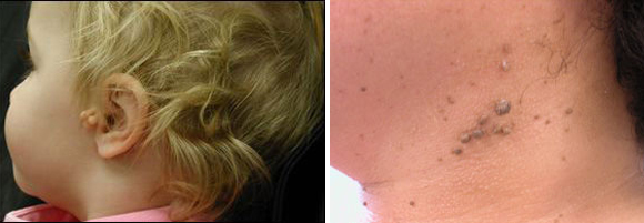Skin Tags Treatment at Chicago Before and After Pictures