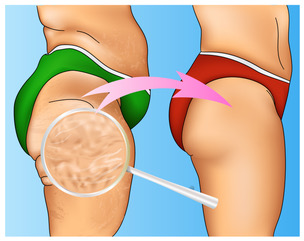 cellulite removal